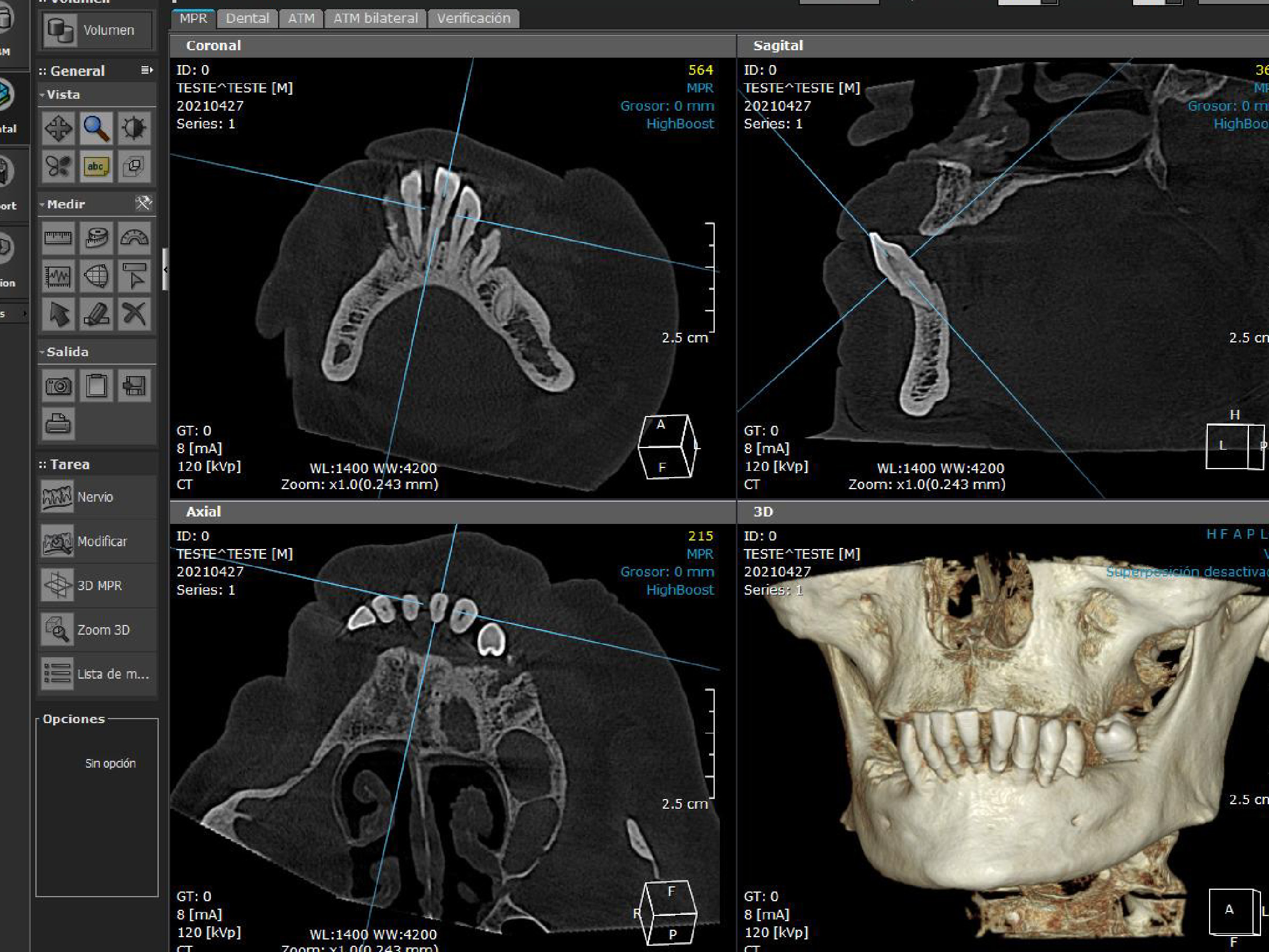 Estudio para Implante (Zona 1.1)